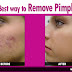 Home Remedies for Acne - Best way to Remove Pimples and Acne