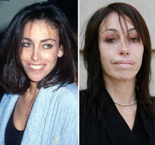 Heidi Fleiss Plastic Surgery 