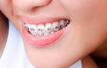 Lưu ý khi niềng răng hô hàm trên