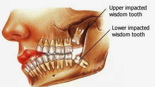 Wisdom Teeth Dental Scam & Why You NEED Your Wisdom Teeth