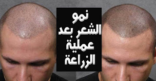 تجربتي مع زراعة الشعر في الرياض