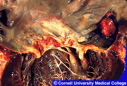 heart disease statistics 2010. Coronary heart disease is the