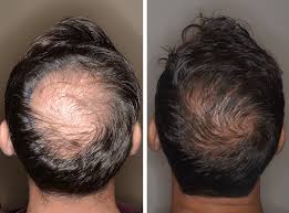 Hair transplant surgery in Lahore