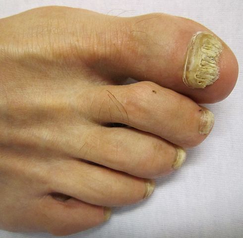 How to Treat Toenail Fungus