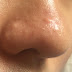 Nose Skin Care