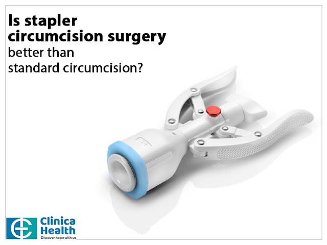 stapler in circumcision surgery
