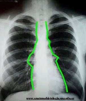 Mediastinolaca radiográfica donde se observa el mediastino, situado entre las líneas verdes