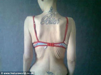 The Fattest Teenager in Britain is now Anorexic