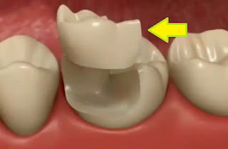 incrustacion dental