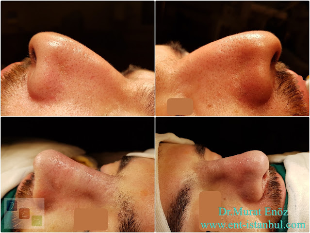 Rhinoplasty in Men Istanbul, Nose Job For Male. Men's Aesthetic Nose Surgery