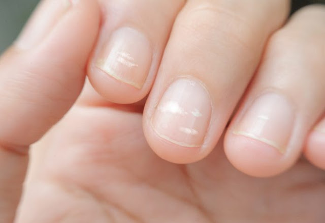 Reasons you get white spots on your fingernails! What to do and how it can be a sign of heart disease