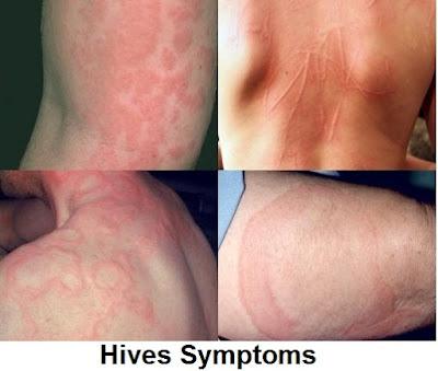 Hives Causes, Symptoms, Diagnosis And Treatment
