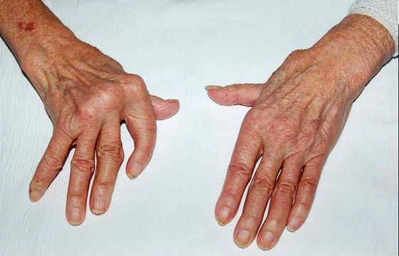 Jaccoud’s arthritis