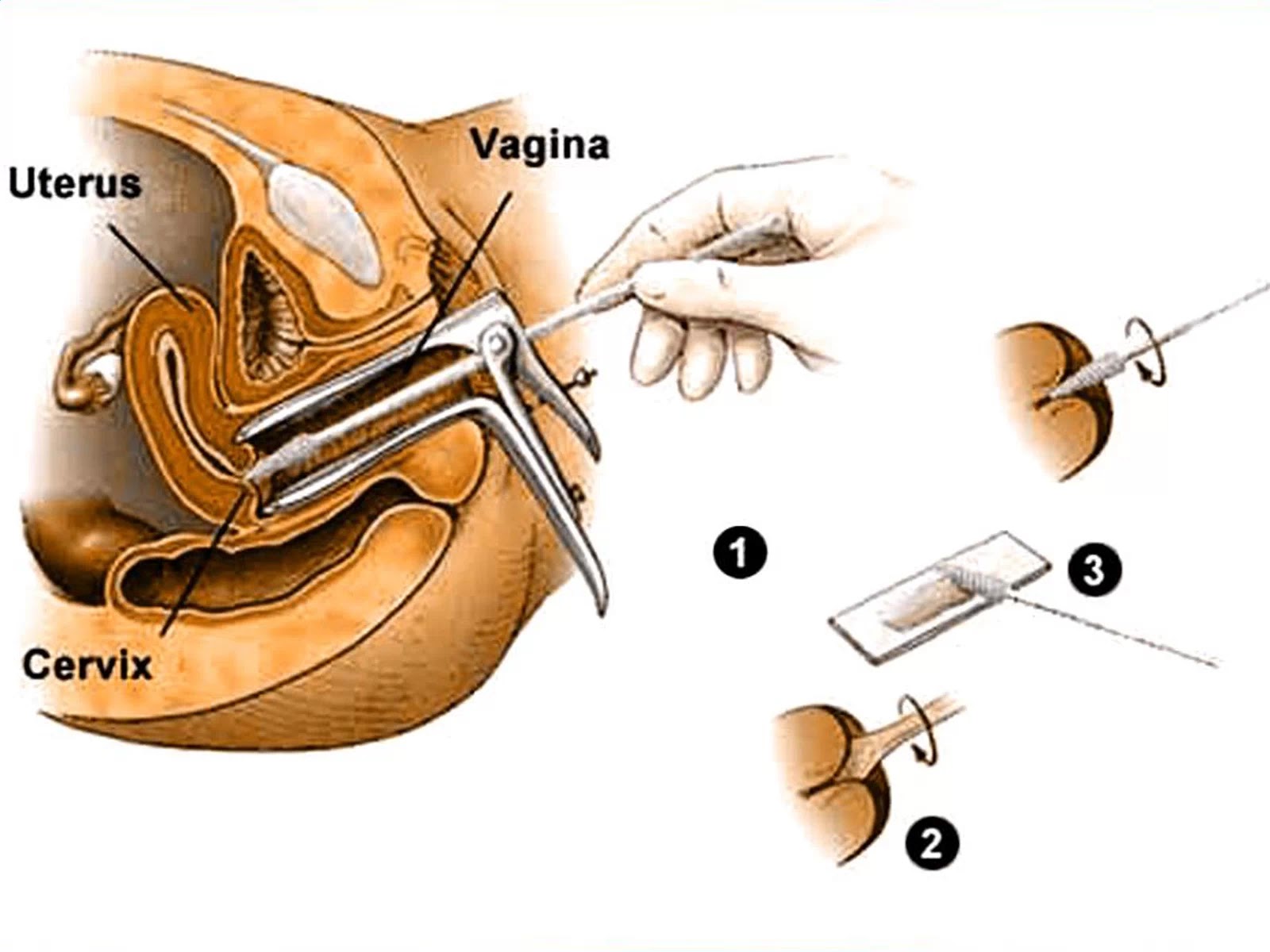 My BLoggeR Pemeriksaan Pap Smear Untuk Deteksi Dini Kanker Serviks