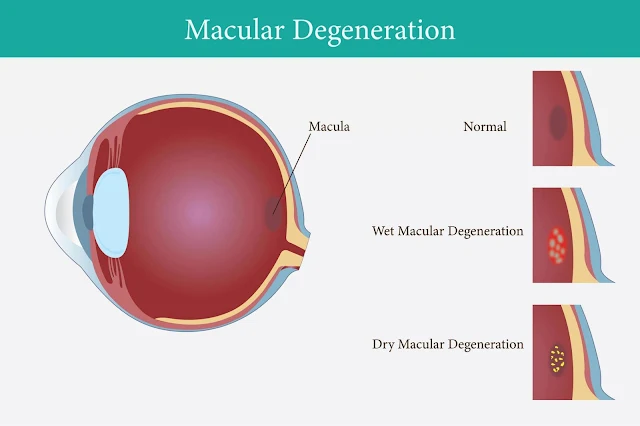 What Are the Key Aspects of Macular Corneal Dystrophy