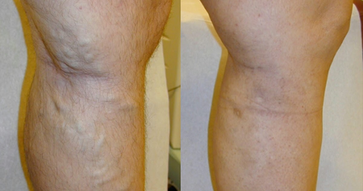Eliminate varicose veins