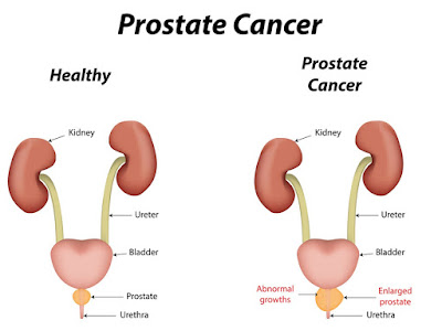 http://www.urologistindia.com/prostate_cancer/