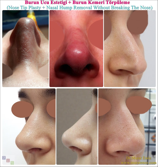 Nasal Hump Removal in Istanbul - Nasal Hump Removal in Turkey - Nasal Hump Rasping Video - Dorsal Hump Removal  Video - Nasal Hump Rhinoplasty Video - Nasal Hump Reduction  Video - Rhinoplasty in Istanbul - Rhİnoplasty in Turkey