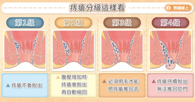 痔瘡分級