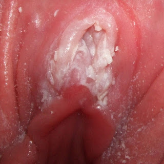 Vaginal Yeast Infection Pictures - 6