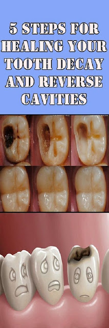 5 TIPS ON HOW TO REVERSE CAVITIES AND HEAL TOOTH DECAY NATURALLY!