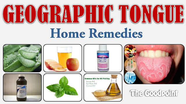 Home Remedies for Geographic Tongue