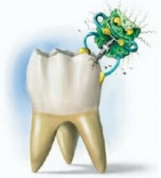 caries dental