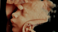 3d Ultrasound Baby1