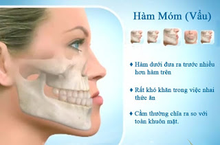 Phẫu thuật hàm móm