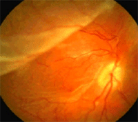 Descolamento de retina