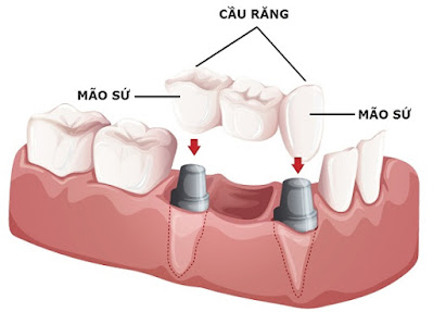 Giải đáp trồng răng cửa giá bao nhiêu 2