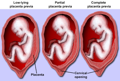 What is Placenta Previa? Definition, Symptoms, Causes, and Treatment