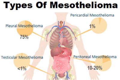 Testicular Mesothelioma