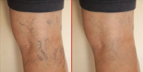 varicose veins