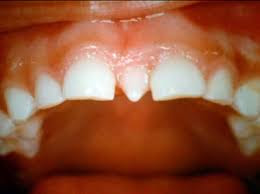 Xử lý răng mọc trong vòm miệng gây khó chịu-1