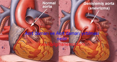 Aort damarı yırtılması