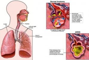 Legionnaires Disease Pictures