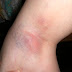Blood Clots: Signs, Symptoms, and Complications
