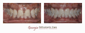 Adult orthodontic treatment, space consolidation, missing teeth, lawrenceville, duluth, norcross, surgar hill, surgar loaf, collins hill, buford, dacula, lilburn, snellville, grayson, doraville, gwinnett, georgia, GA, 30043, 30044, 30045, 30093