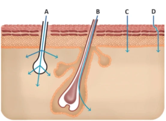 A epilação a laser é um recurso estético que vem sendo cada vez mais utilizado em clínicas de estética para a remoção de pelos de forma definitiva ou prolongada