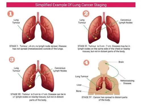 Stage-Kanser-Paru-Paru
