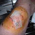 ANTI-INFECTIVE AGENTS (IODOPHORES, BENZALKONIUM CHLORIDE & GENTIANVIOLET) 