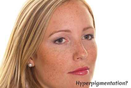 ACSP Shop Blog Hyperpigmentation Skincare