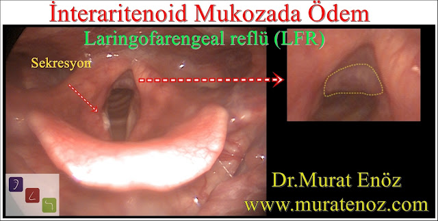 laringofarengeal reflü - ekstraözofageal reflü - sessiz reflü - interaritenoid ödem