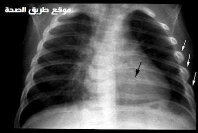 صورة بأشعة X توضح وجود كسور بالأضلاع