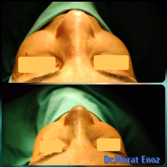 nose reshaping, nose job, Natural rhinoplasty in Istanbul,Natural looking nasal aesthetic surgery