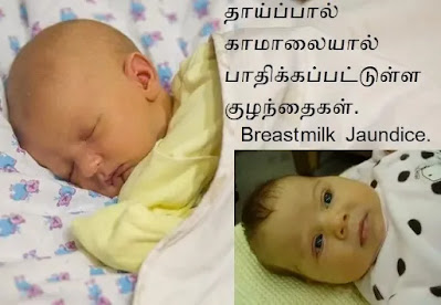 Breastmilk Jaundice