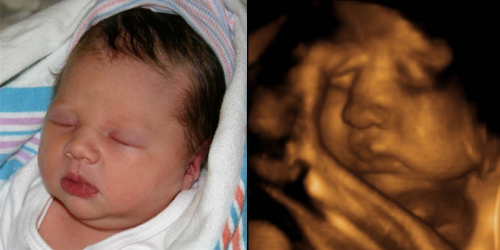 3d Ultrasound Baby