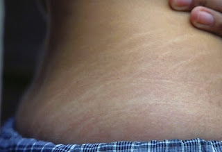 Penyebab dan Pencegahan Stretch Mark