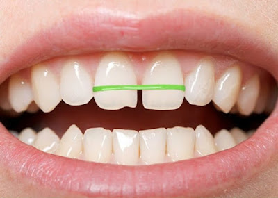 Tự niềng răng tại nhà có hiệu quả không?